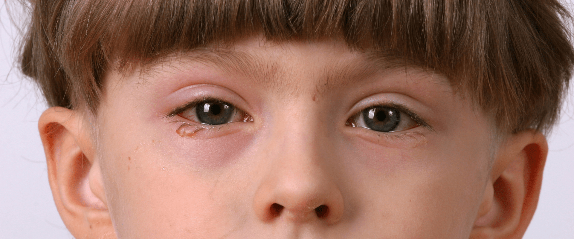 Коньюктивит у ребенка 5. Поллинозный конъюнктивит. Аллергенный конъюнктивит. Аллергический конъюнктивит отек глаз. Аллергический конъюнктивит глаза у детей.